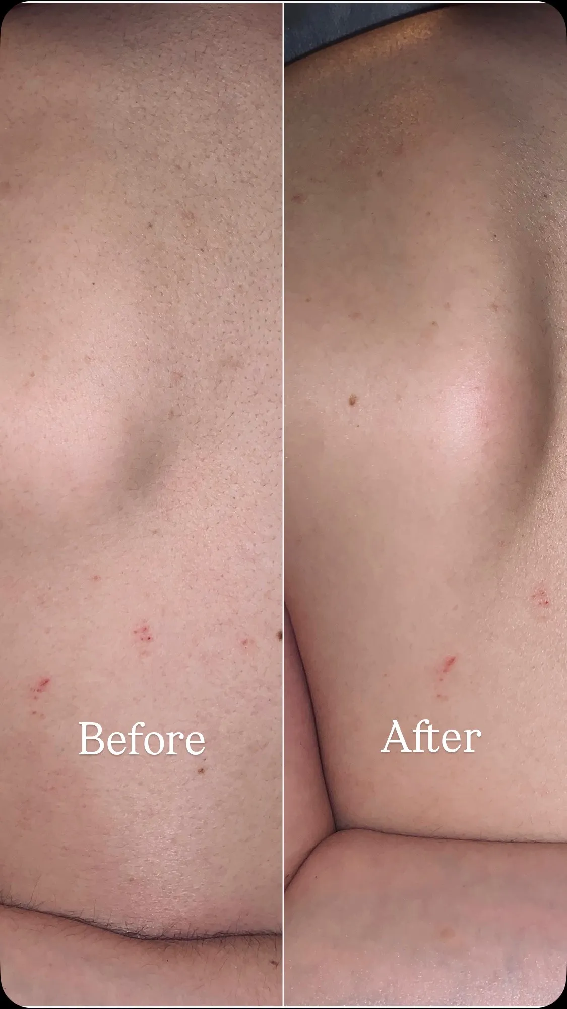 肩甲骨はがし-Before After-